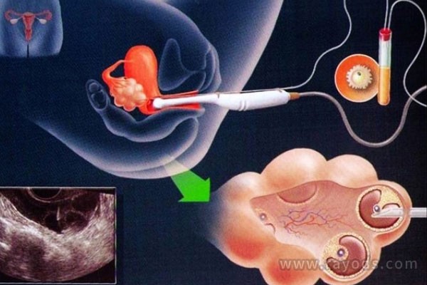 移植的胚胎质量低，胎儿会畸形吗？